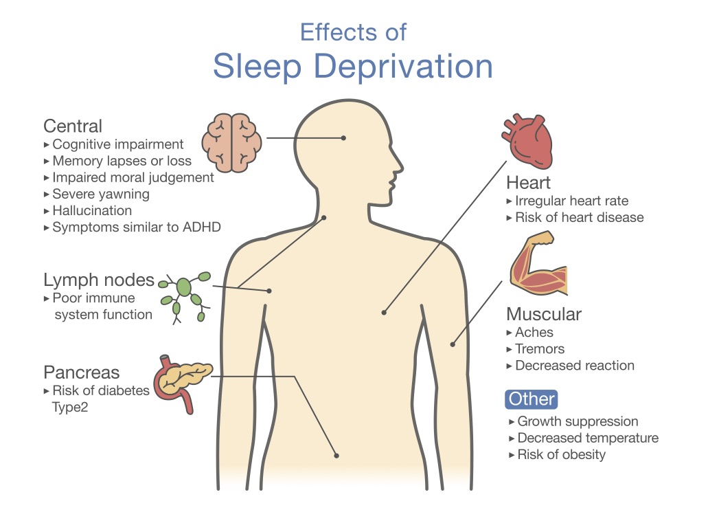 Effects of Sleep Deprivation Sleep Deprivation